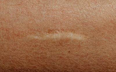 Blizny – czym są, jakie są ich rodzaje, jak się je usuwa i czy to bezpieczne?