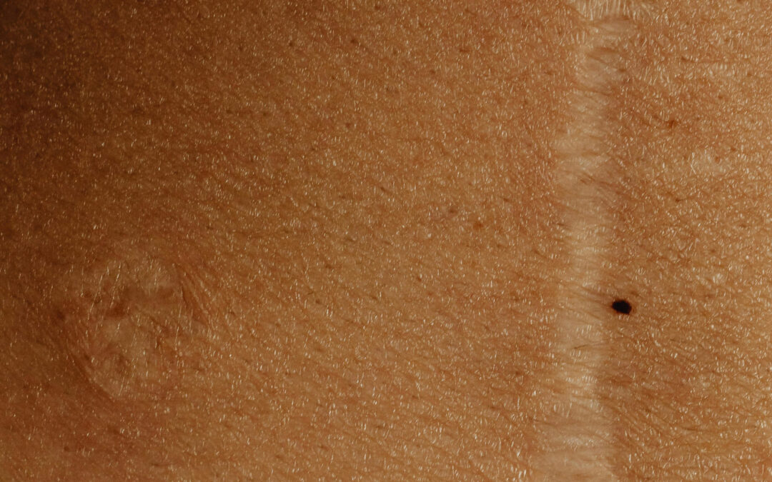 Jak zapobiegać tworzeniu się blizn i jak je leczyć wg. badań naukowych