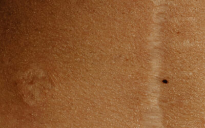 Jak zapobiegać tworzeniu się blizn i jak je leczyć wg. badań naukowych