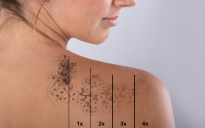 Laser pikosekundowy – skuteczne usuwanie tatuaży i leczenie blizn